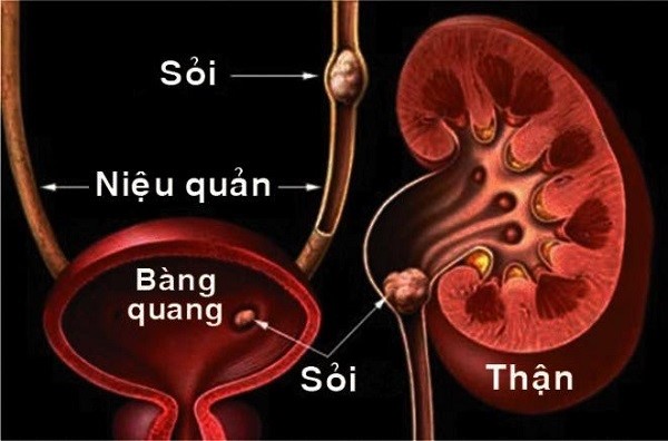 Hình thành sỏi